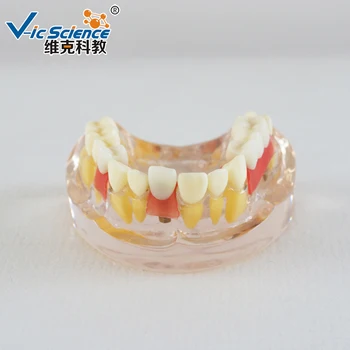 Implantát Demonštrácia Model Pol úst, zubný implantát model